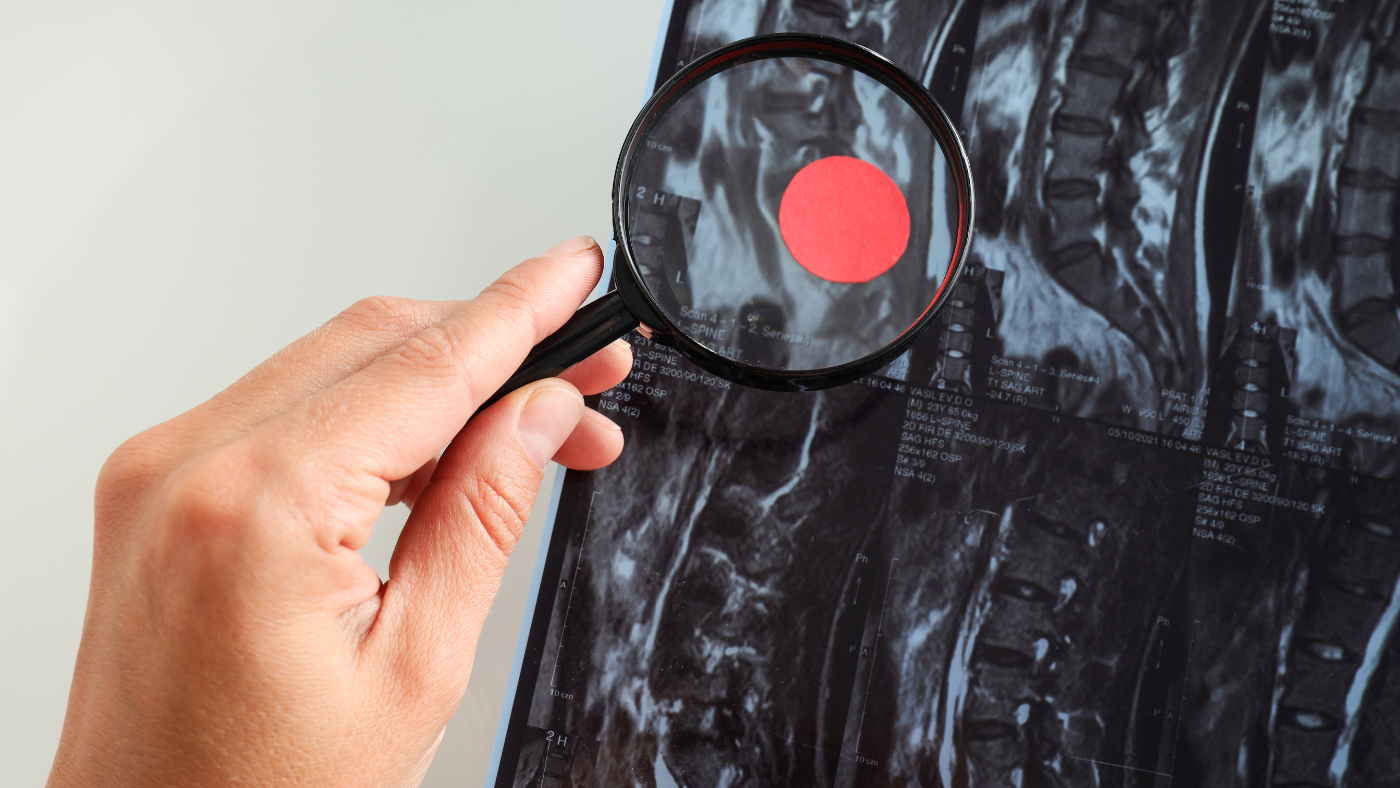 Magnetická rezonancia ako možnosť diagnostiky spondylartrózy